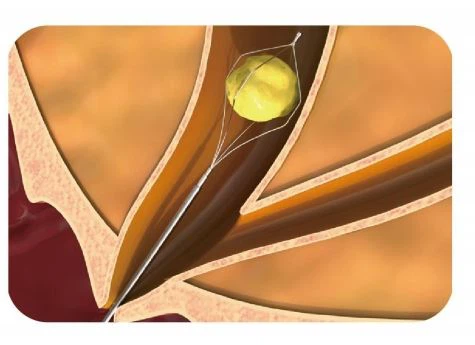 Disposable Endoscope Stone Extraction Basket